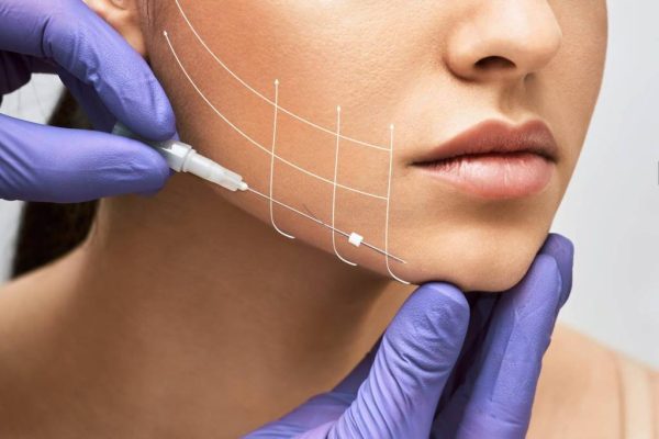 Hilos tensores rostro y cuello