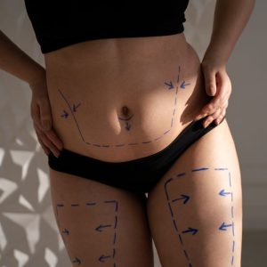 Criolipolisis